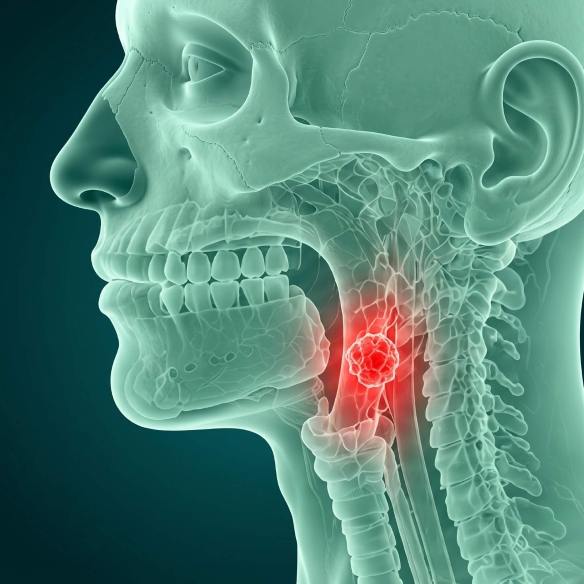 Throat Cancers (Laryngeal and Pharyngeal Cancers) - About